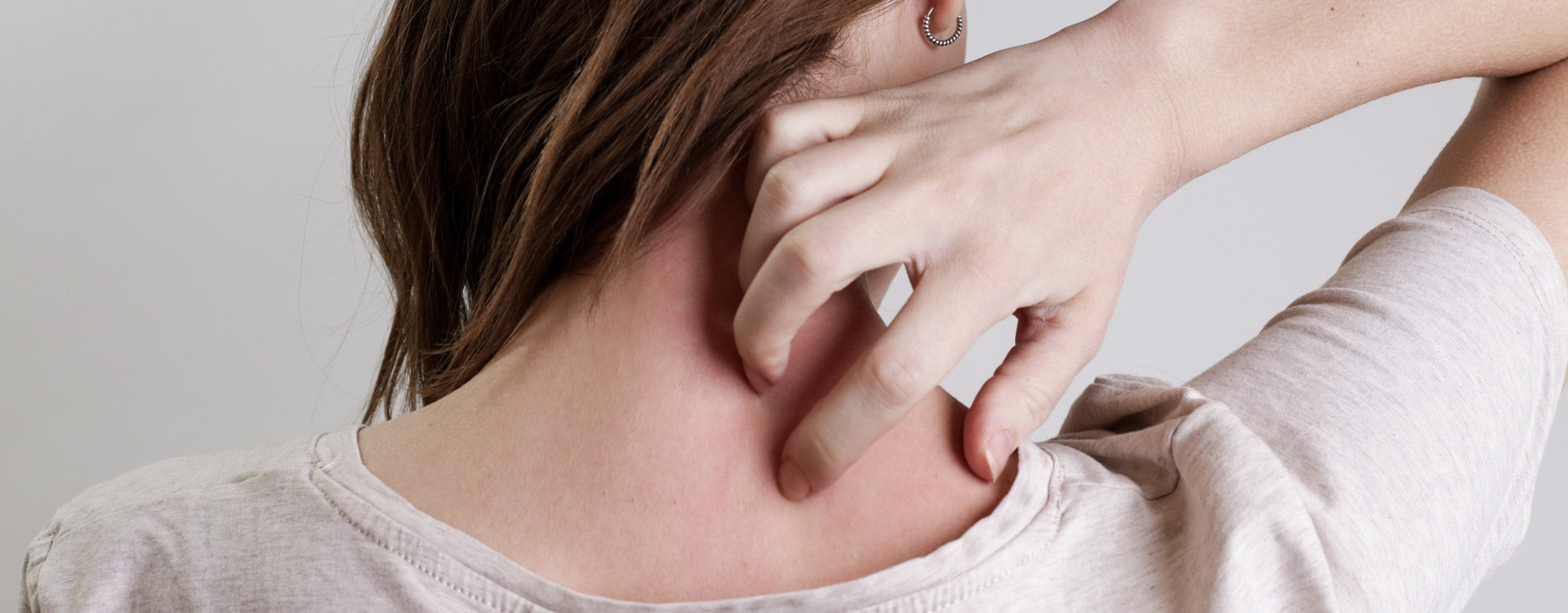 Traiter l'eczéma avec les huiles essentielles