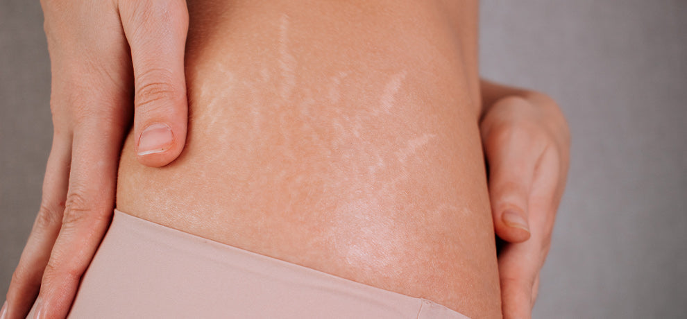 huile essentielle pour les vergetures